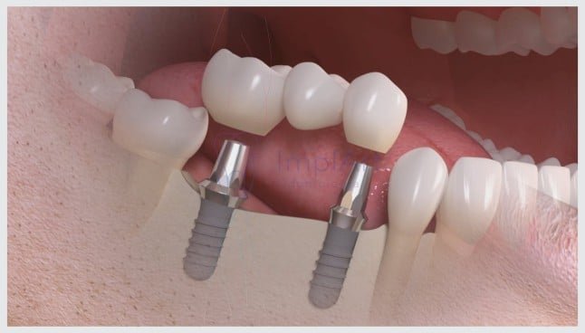 Implantes Dentários em Lavras