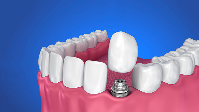 Implantes Dentários em Lavras
